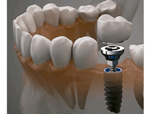 Implantes Dentários