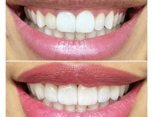 Clareamento Dental